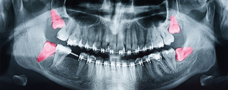 Digital Radiography  - White Pine Family Dentistry - Hamilton ON
